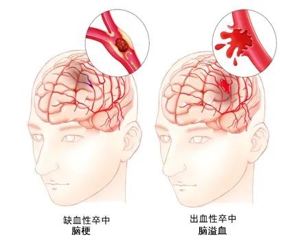 彩色經顱多普勒超聲TCD：腦血管血流情況檢查