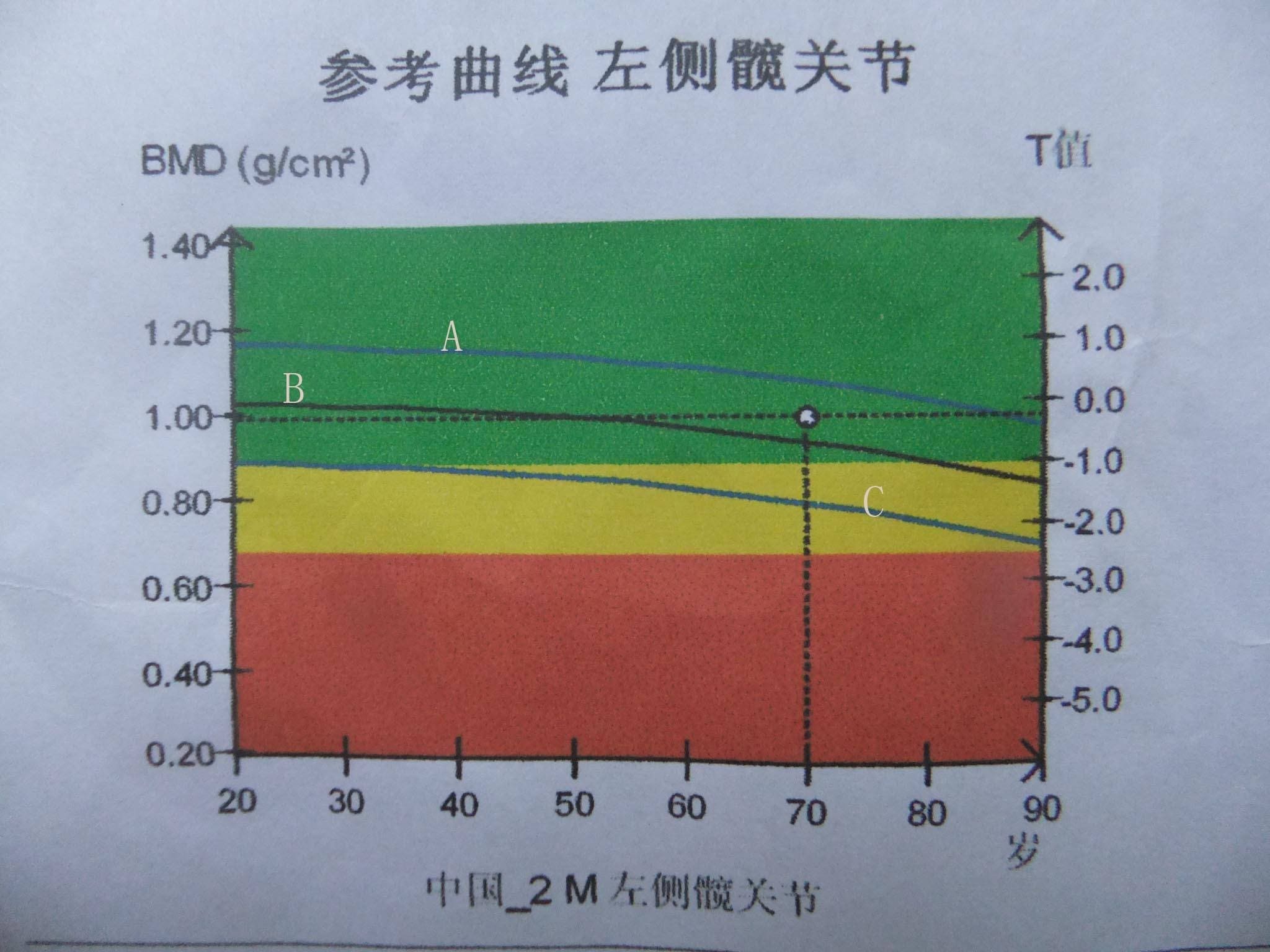 骨密度T值正常范圍是多少